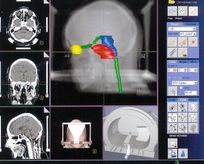 Hirntumor Treatment-Plan